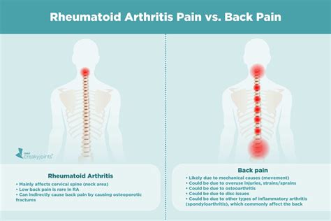 Causes of Rheumatoid Arthritis Pain Aside from Inflammation