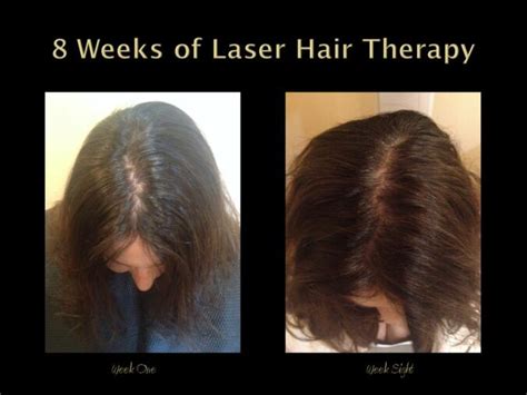 Treat hair loss with Low-Level Laser (Light) Therapy (LLLT) - Laser hair growth: Does it work ...