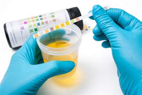 Urine sodium test, urine sodium interpretation & urine sodium pathophysiology