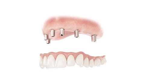 How Much Do Dentures Cost in Ontario? - McCabe Dentures & Implants