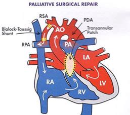 BT Shunt Surgery Cost India| Palliative Pediatric Cardiac Surgery India