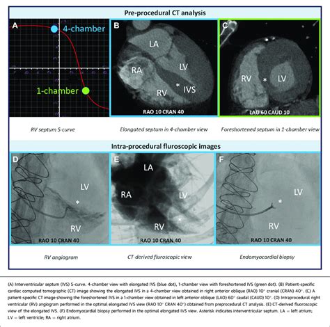 Endomyocardial Biopsy: CT-Guided Procedure Planning | Download Scientific Diagram