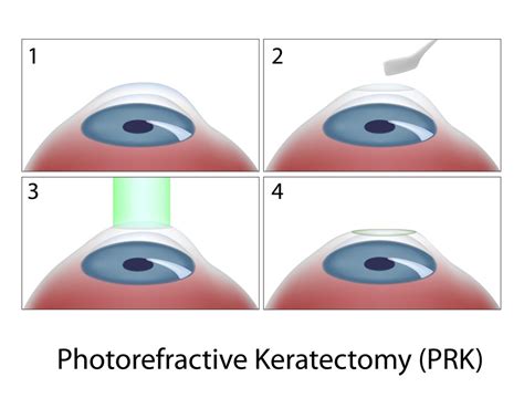 LASIK vs LASEK vs PRK | Laser Eye Surgery Hub