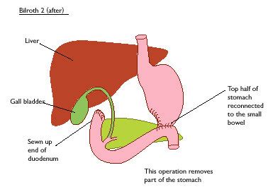 Laparoscopic Removal of GIST (Stomach) - Dr Rajat Goel