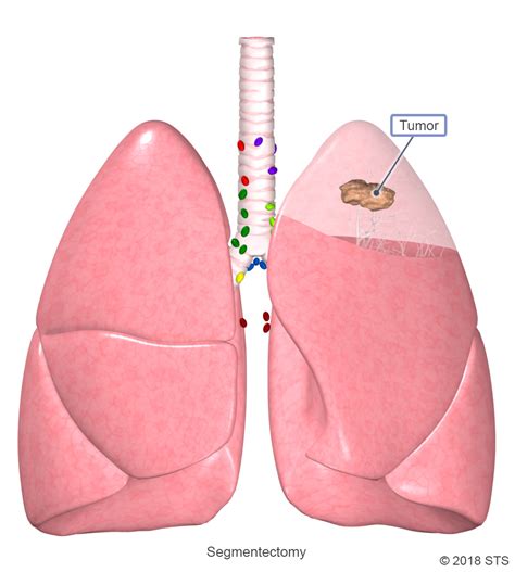 Lung Cancer | The Patient Guide to Heart, Lung, and Esophageal Surgery