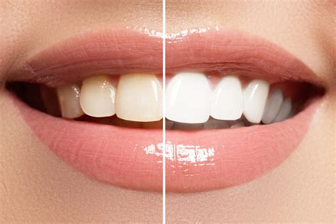 KOR Whitening System - Cori S. Hvideberg, DMD