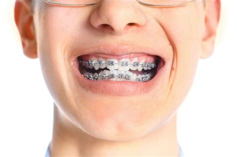 Preparing Children for Child Orthodontics - Hardy Pediatric Dentistry & Orthodontics