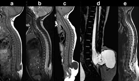 False Chiari I malformation in lipomyelomeningocele. a, b Spinal MRI... | Download Scientific ...