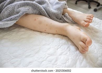 Childs Legs Hair Bruises Many Red Foto stock 2025306002 | Shutterstock