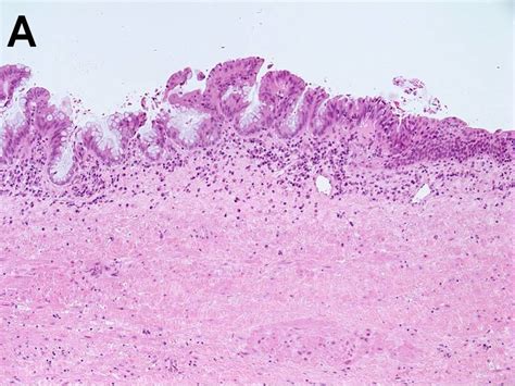 A. Histopathological examination of borderline mucinous tumour of the ...