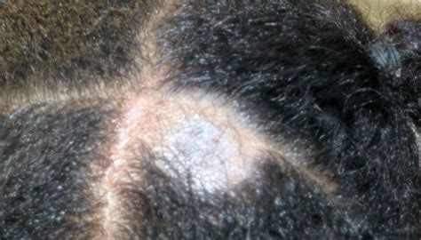 Tinea capitis (scalp ringworm): Causes, symptoms, and treatments - Medical News Today