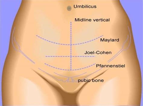 Cesarean Section/Cesarean Delivery - Stepwards