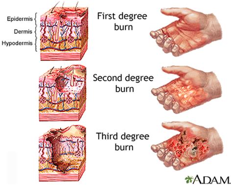 Fourth Degree Burn Diagram