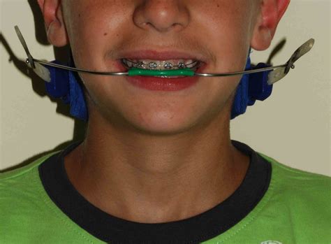 Épinglé par jamie richie sur BRACES & HEADGEAR | Orthodontie