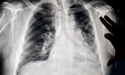 Black lung disease is still killing coal miners, and the coal industry ...