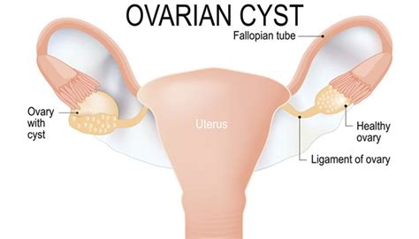 4 Signs of Ovarian Cysts | Womens Medical Nashville