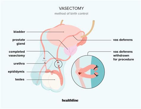 Vasectomy: Procedure, Benefits, and Risks