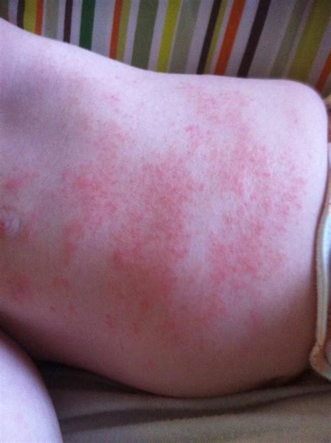 baby egg allergy skin rash - Jeanetta Schmid