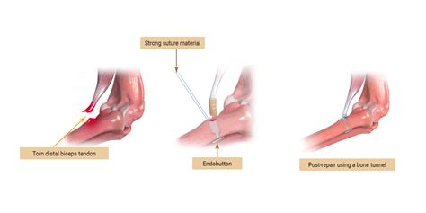 Distal Biceps Tendonitis