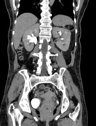 Renal Papillary Necrosis Usmle