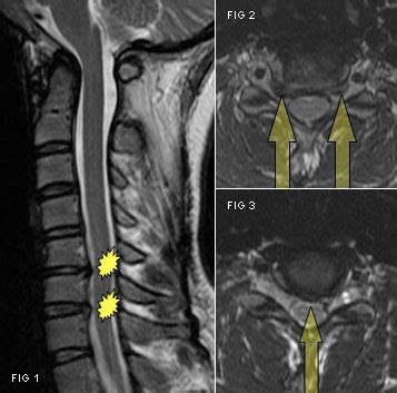 Cervical Disc Mri