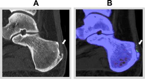 Plantar Calcaneal Enthesophyte