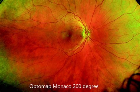 Optomap Retinal Eye exam at Fine Eyewear with 2 locations - Austin,TX ...