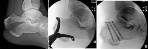 Revision surgery for tongue type calcaneal fracture complicated by ...