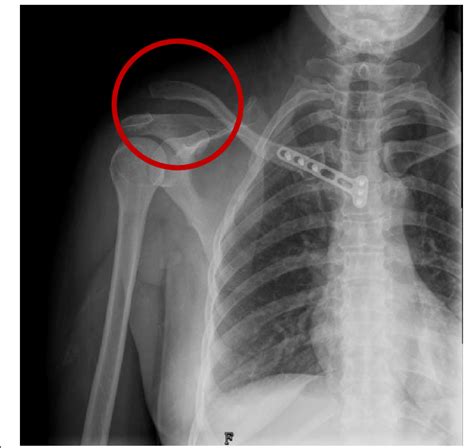 Shoulder X Ray Right Acromioclavicular Joint Dislocation Radrounds ...