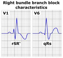 emDOCs.net – Emergency Medicine EducationECG Pointers: RBBB in ACS - emDOCs.net - Emergency ...