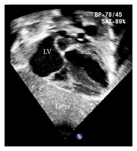 Basic transthoracic echo views: (a) left parasternal long axis, (b)... | Download Scientific Diagram