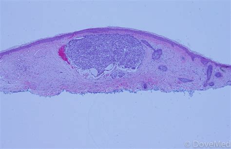 Nodular Basal Cell Carcinoma of Skin