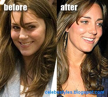 Kate Middleton Surgery before and after:Celebrity Cosmetic Surgeon