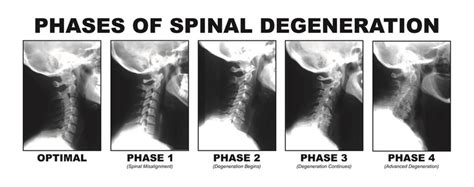 Chiropractor in New Britain | Spinal Degeneration in New Britain | Michael Brady