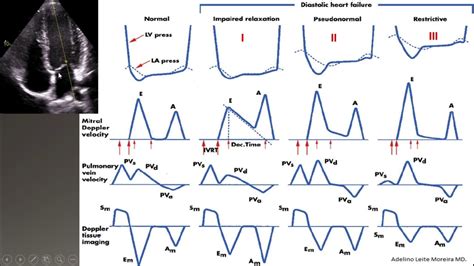 diastolic dysfunction part II-grading ASE 2016 - YouTube