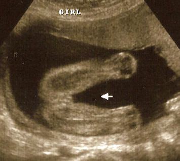 What Does a Baby Girl Look Like on Ultrasound?