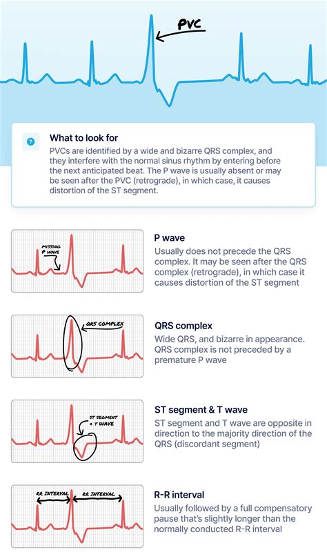 Premature Ventricular Contractions Signs Symptoms And - vrogue.co