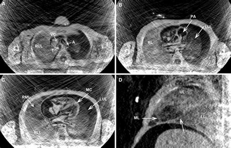 Preservation of the intrathoracic organs and structures. (A) Axial MPR ...