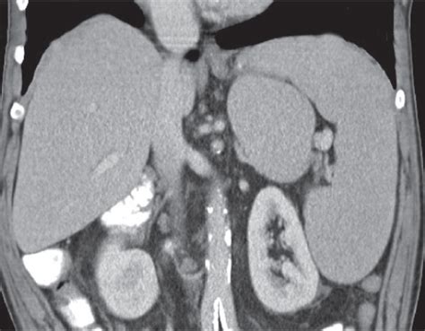 21 Spleen | Radiology Key