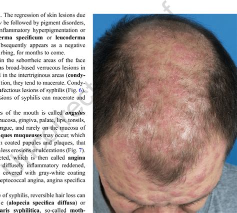 Syphilis II: syphilids on the scalp and seborrheic areas of the face ...