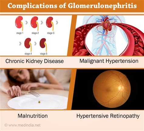 Glomerulonephritis Causes Symptoms Treatment And Prevention