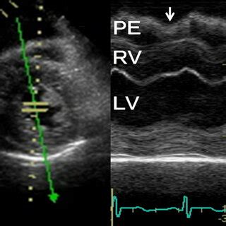 A. Echocardiogram of short axis at the level of papillary muscle before... | Download Scientific ...