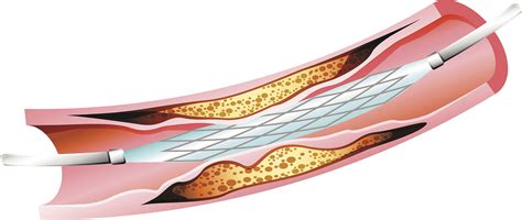 When do you need a heart stent? - Harvard Health