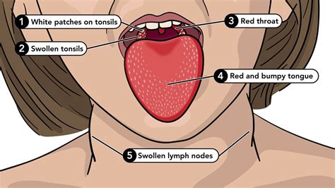 Symptoms of Scarlet Fever | Group A Strep | CDC