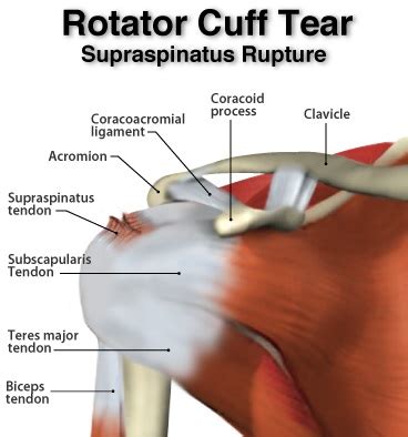 Supraspinatus Tendon Tear What Are Its Main Causes Symptoms And | The ...