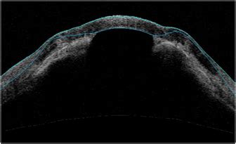 ASOCT image showing peripheral anterior synechiae approaching... | Download Scientific Diagram