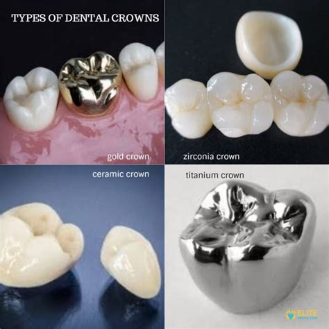 Elite Dental CareTYPES OF DENTAL CROWNS - Elite Dental Care