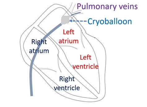 What is cryoablation? – All About Cardiovascular System and Disorders