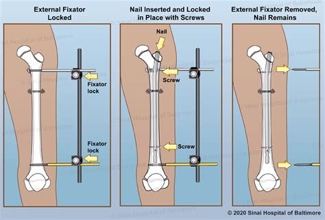 Fixator-Assisted Nailing (FAN) | International Center for Limb Lengthening