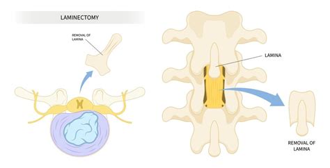 Exercises to Avoid After Lumbar Laminectomy